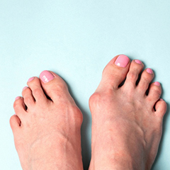 Hallux Valgus Hilfe: Korrektur und Linderung Foto